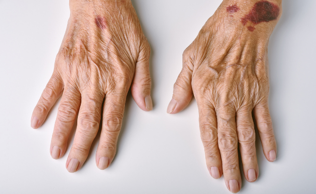 How to Treat Immune Thrombocytopenic Purpura?