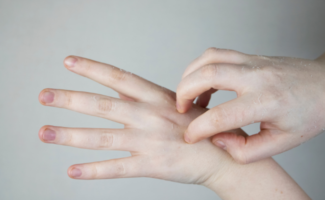 How to Treat Fungal Infections?