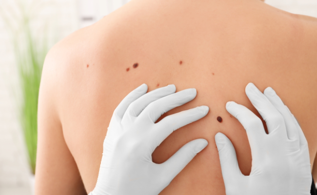 How to Treat Epidermal Nevus?