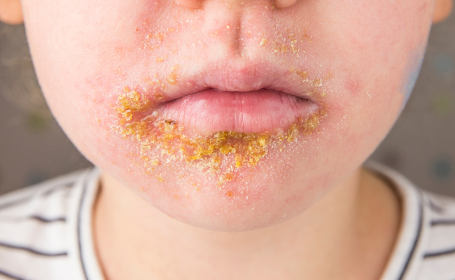 How to Treat Impetigo?