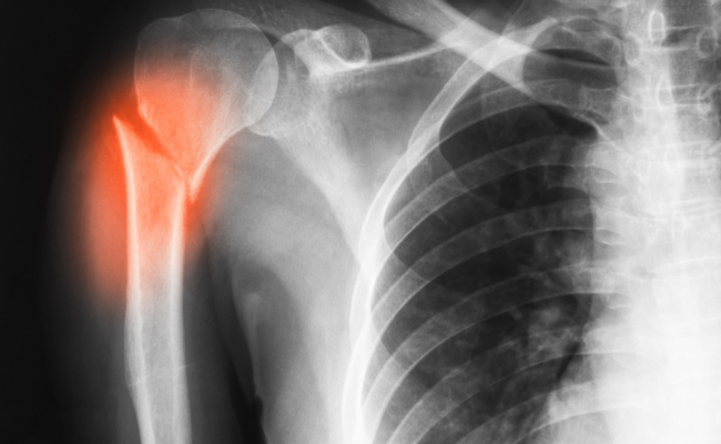 How to Treat Comminuted Fracture?
