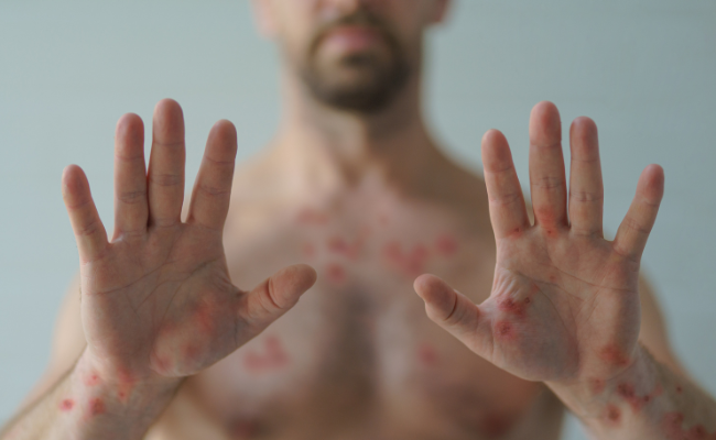 How to Treat Itchy Finger?