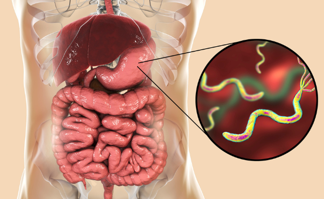 How to Treat Helicobacter Pylori?