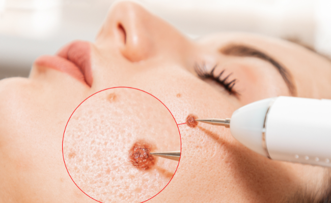 How to Treat Flat Warts?