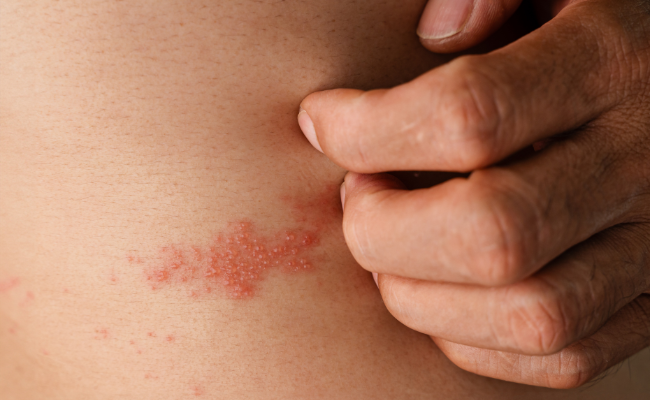 How to Treat Staphylococcus Ssp?