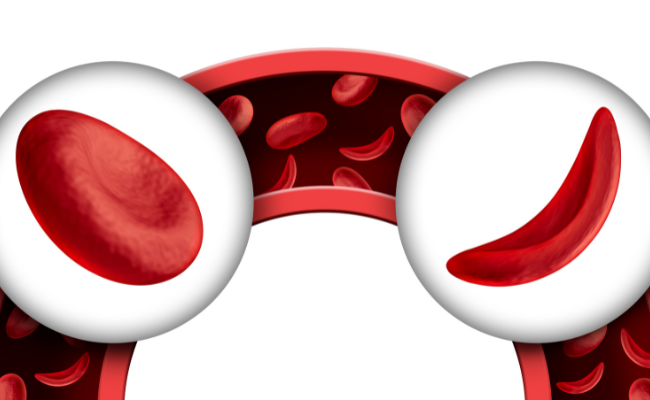 How to Treat Anaemia Sickle Cell?