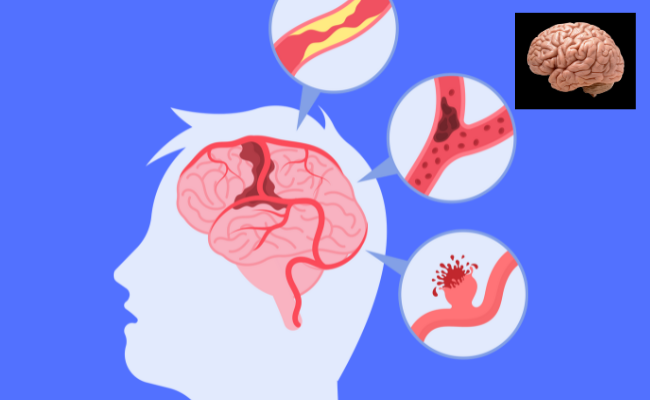 How to Treat Subarachnoid Hemorrhage?