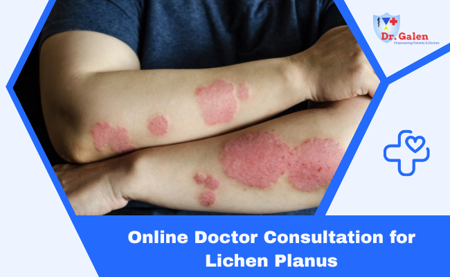 Online Doctor Consultation for Lichen Planus