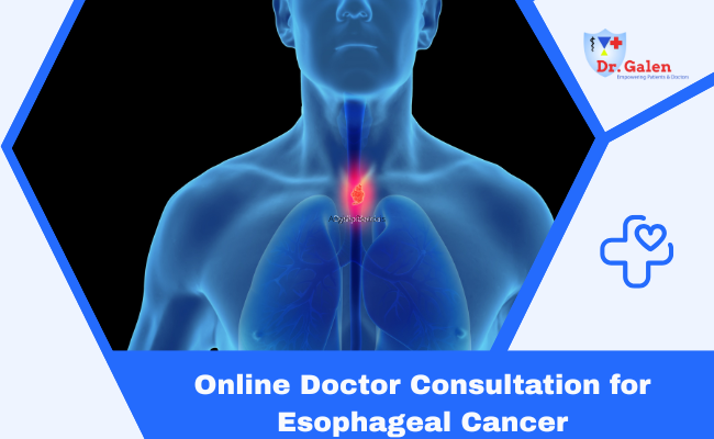 Online Doctor Consultation for Esophagus Cancer